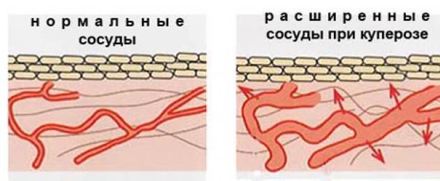 Мелкая сосудистая сетка на лице. Причины появления сосудистой сетки на лице (купероз) и как от неё избавиться