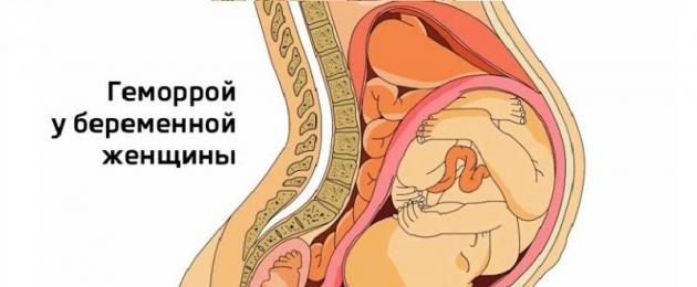 Что такое геморрой при беременности. Нужно ли беременной женщине лечить геморрой? Новый режим дня