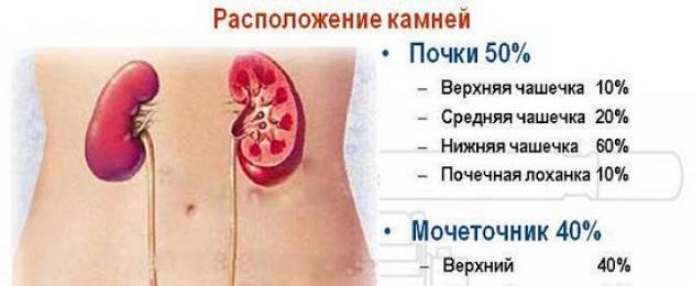 Идет камень из почки симптомы. Как выходят камни из почек – симптомы, что делать во время выведения