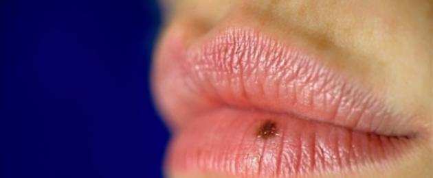 Меланоцитарное пятно или лентиго губы. Пигментация губ. Почему появляются пятна и что они значат