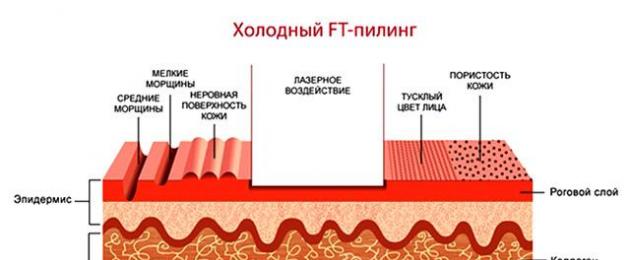  Способы омоложения лица: лазерный пилинг